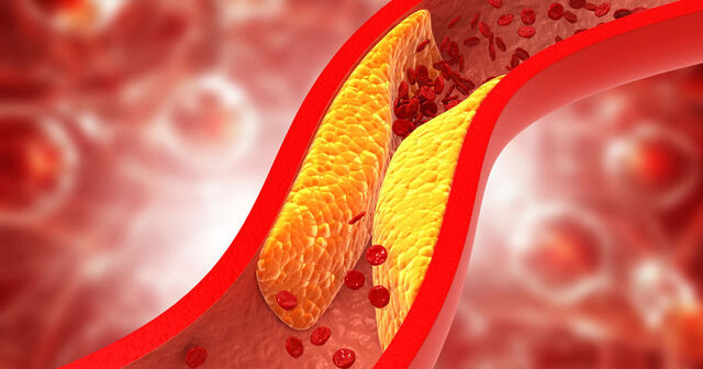 Lipids-artery-iStock-1255871988.jpg