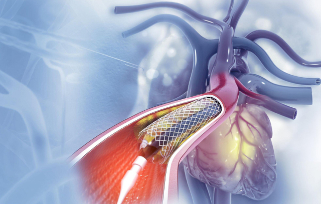 article-cardiac-intervention-2.jpg